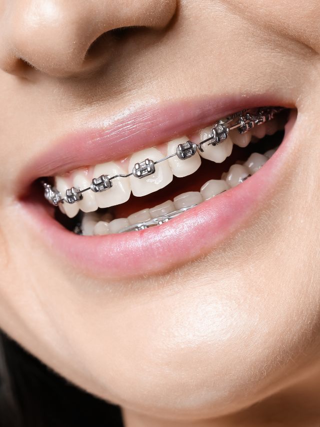 Can you have an MRI with dental braces? MRI Chandigarh