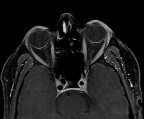 Contrast MRI PNS