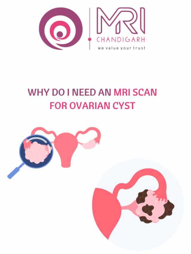 Why do I need an mri scan for ovarian cyst