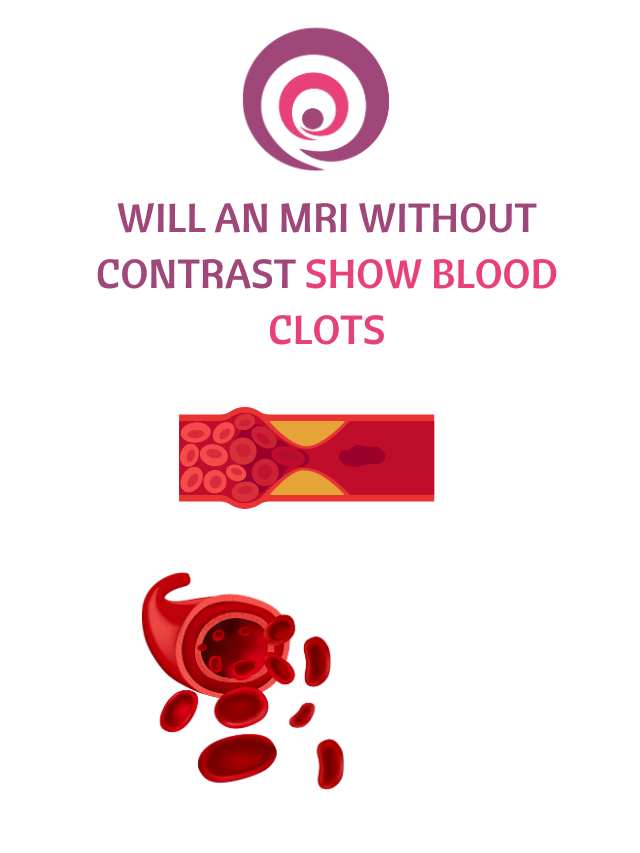 will an mri without contrast show blood clots