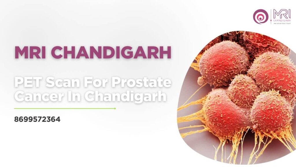 PET Scan For Prostate Cancer In Chandigarh 8699572364