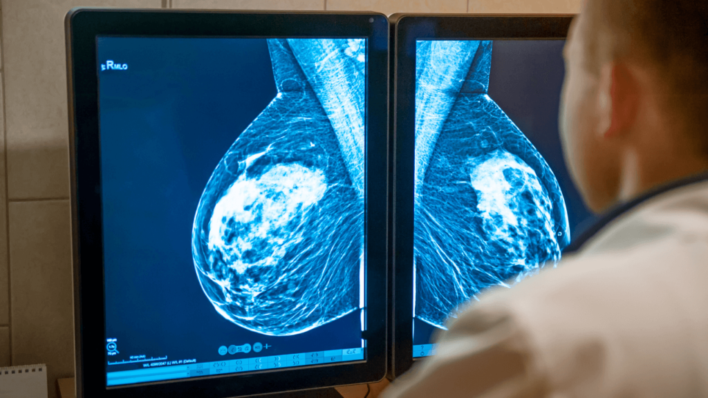 PET Scan For Breast Cancer In Chandigarh 8699572364