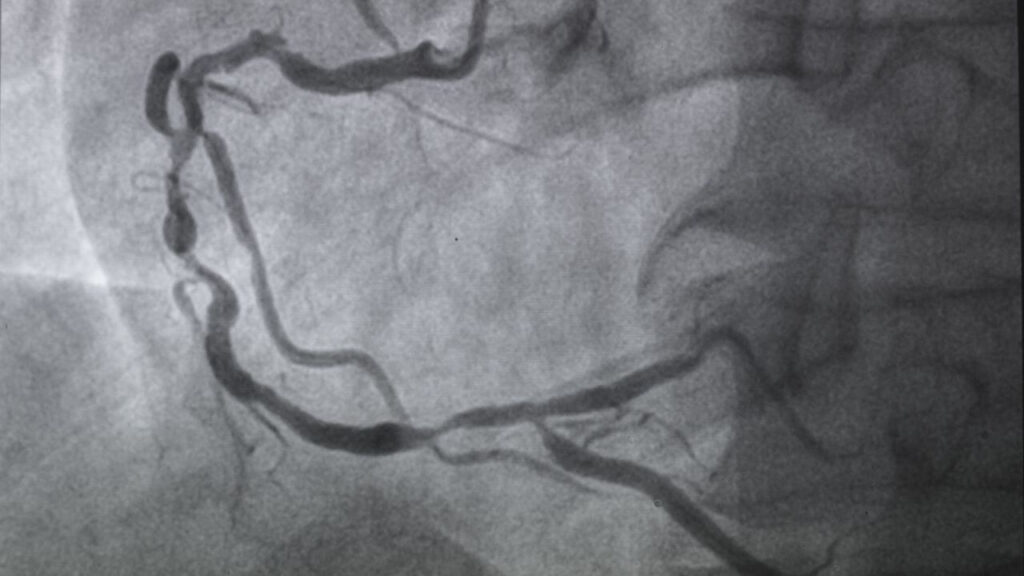 ct angiography cost in pgi chandigarh