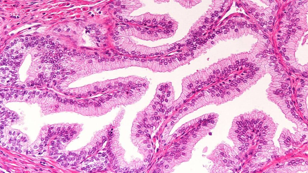 psma pet scan after radiation 8699572364