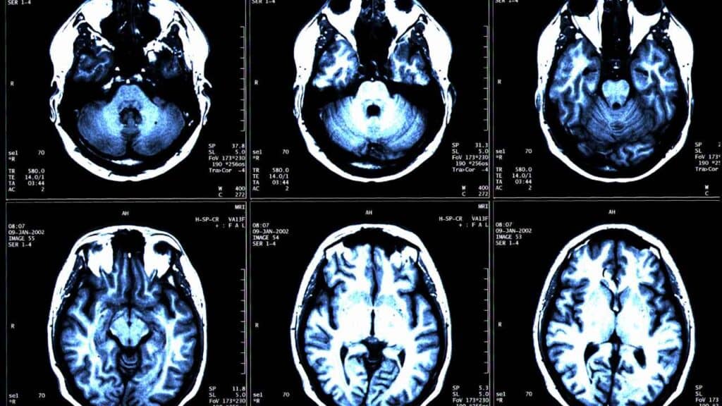 FDG PET scan - 8699572364