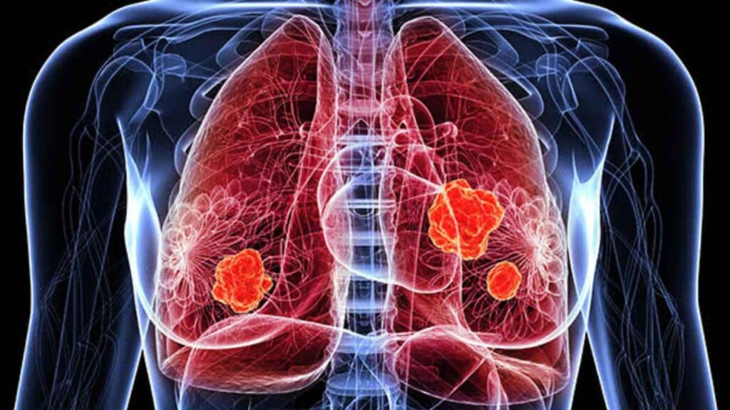 How accurate is a PET scan for lung cancer
