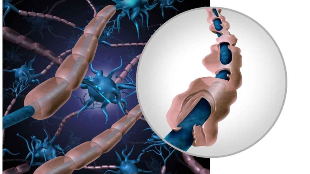 Multiple myeloma Radiology - 8699572364