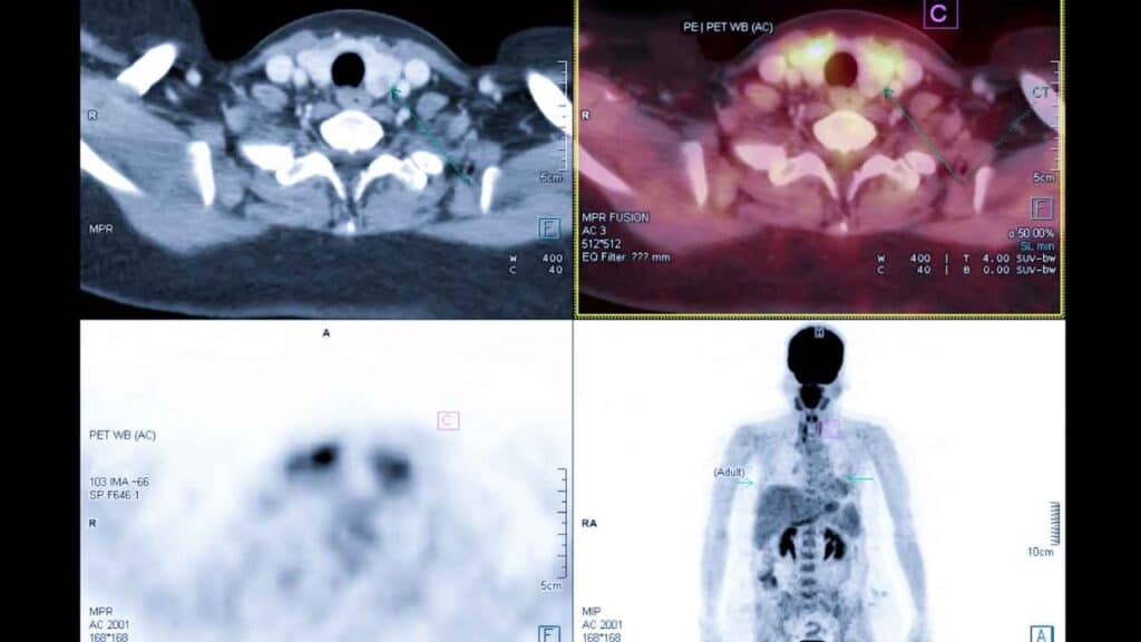 PET scan cost-8699572364
