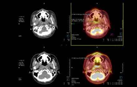 What happens if a PET scan is positive?-8699572364