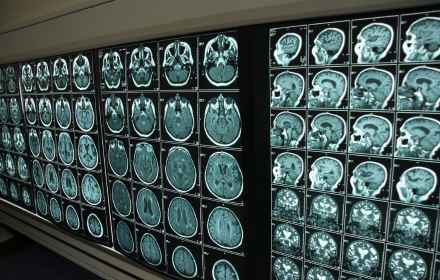 What is a PET scan for the brain?-8699572364