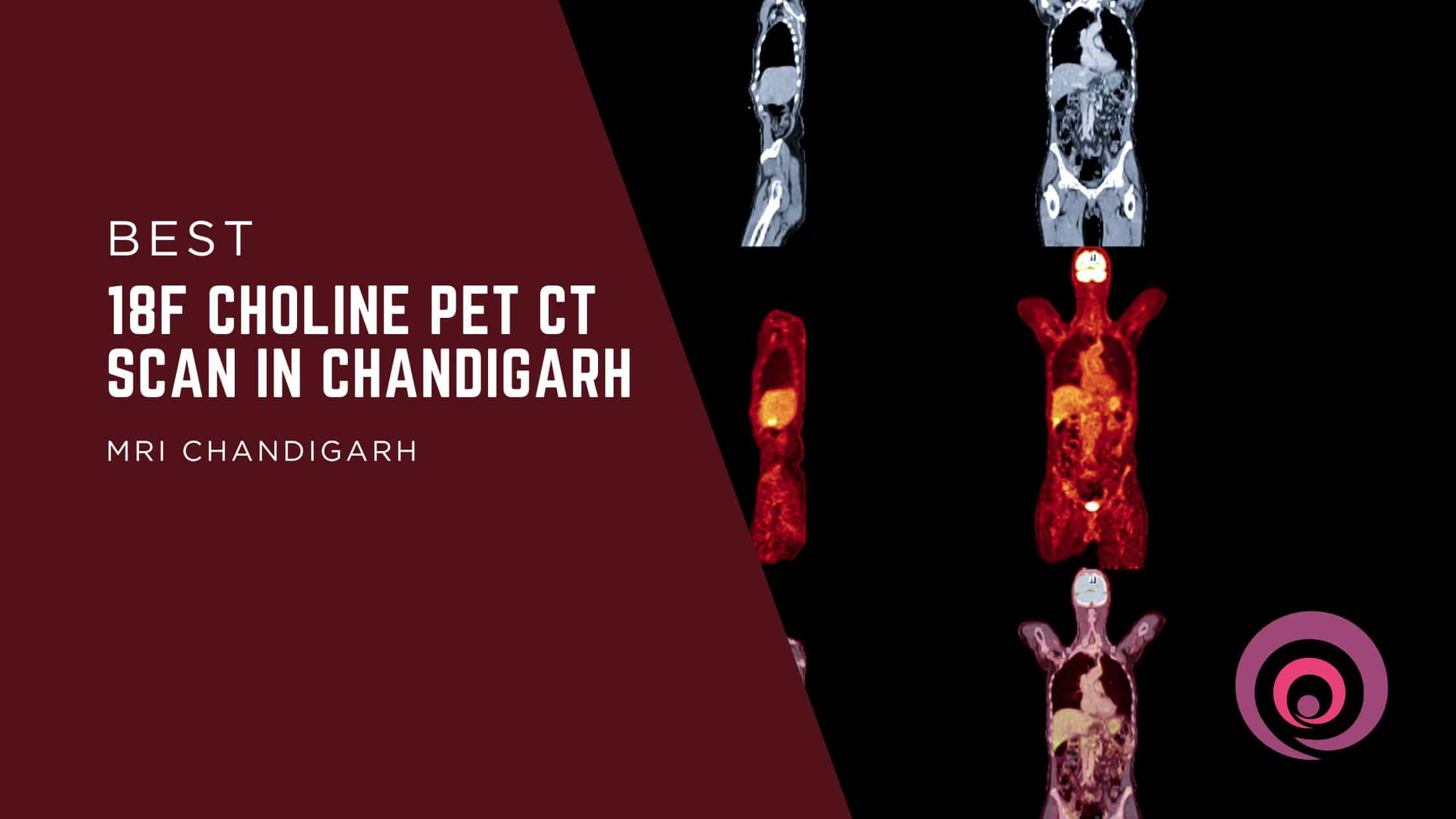 18F Choline PET CT Scan in Chandigarh
