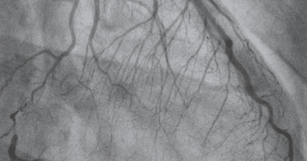 ct coronary angiography