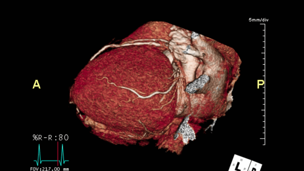 ct coronary angiography in chandigarh