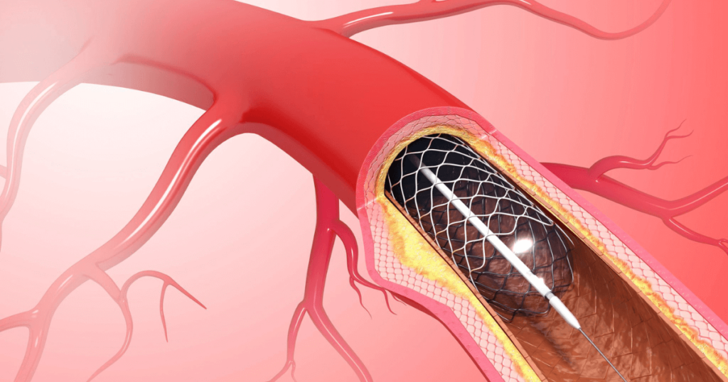 ct scan for heart blockage