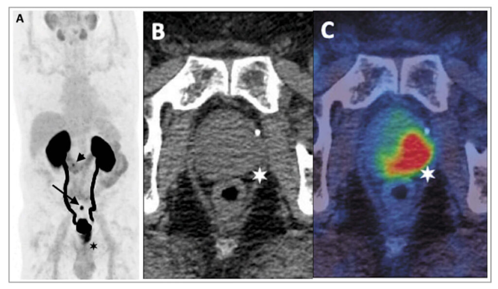 prostate cancer psma pet scan imaging