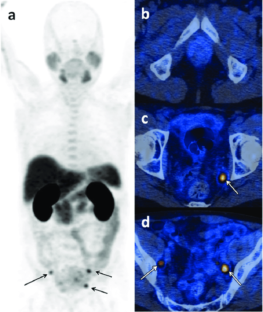 choline PET CT scan showing prostate cancer tracer uptake