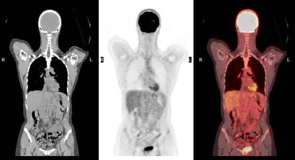 DOTA PET scan imaging for neuroendocrine tumors