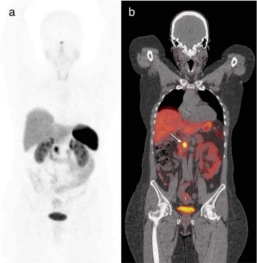DOTA PET scan used for neuroendocrine tumor detection