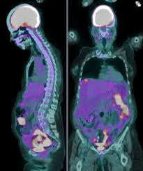 Ga-68 DOTATATE PET CT imaging technique