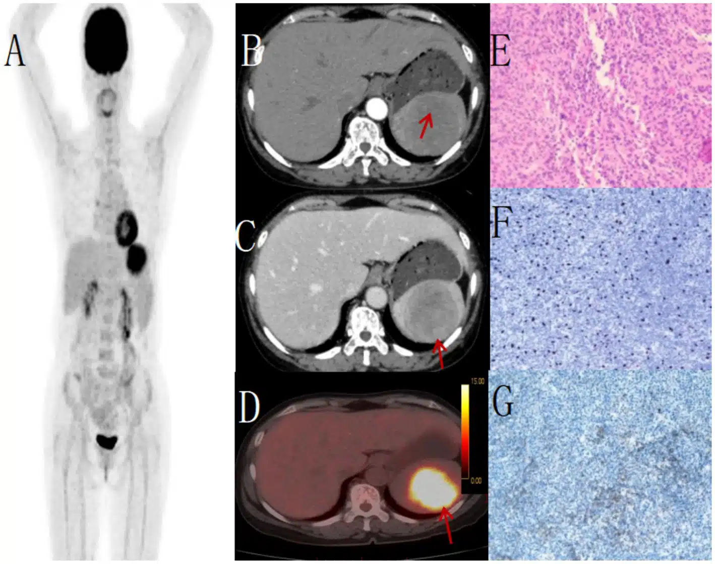 PET-CT image: red cancer hotspot overlay