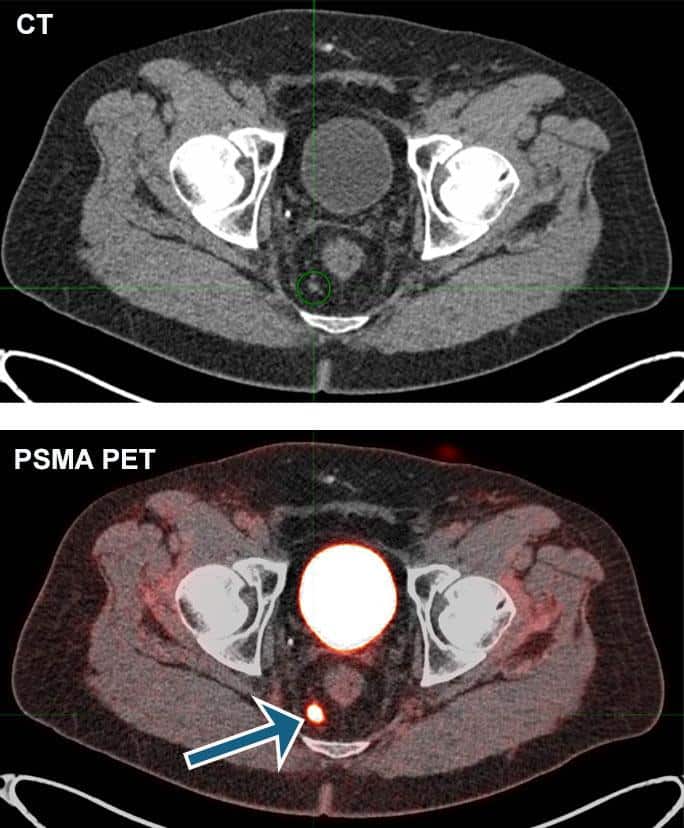 PSMA PET-CT scan images used for advanced prostate cancer detection