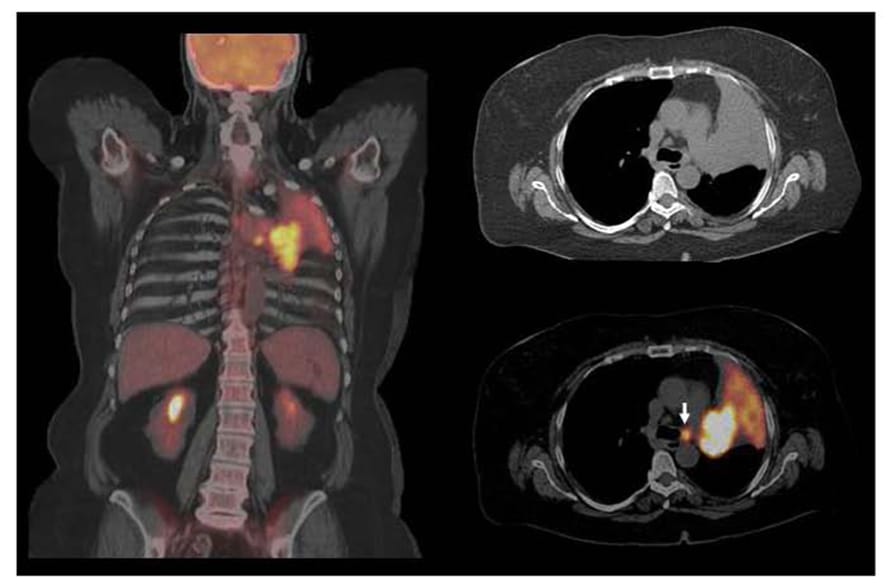 Cancer detection via PET-CT hotspot scan