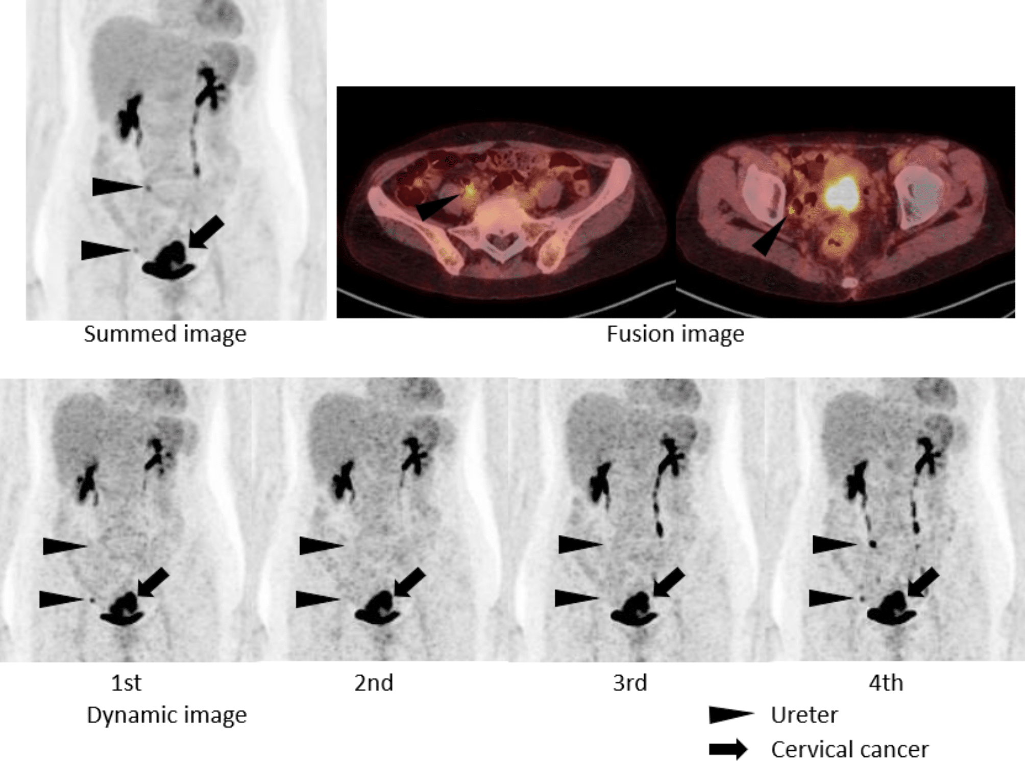PET-CT scan highlighting tumor metabolism