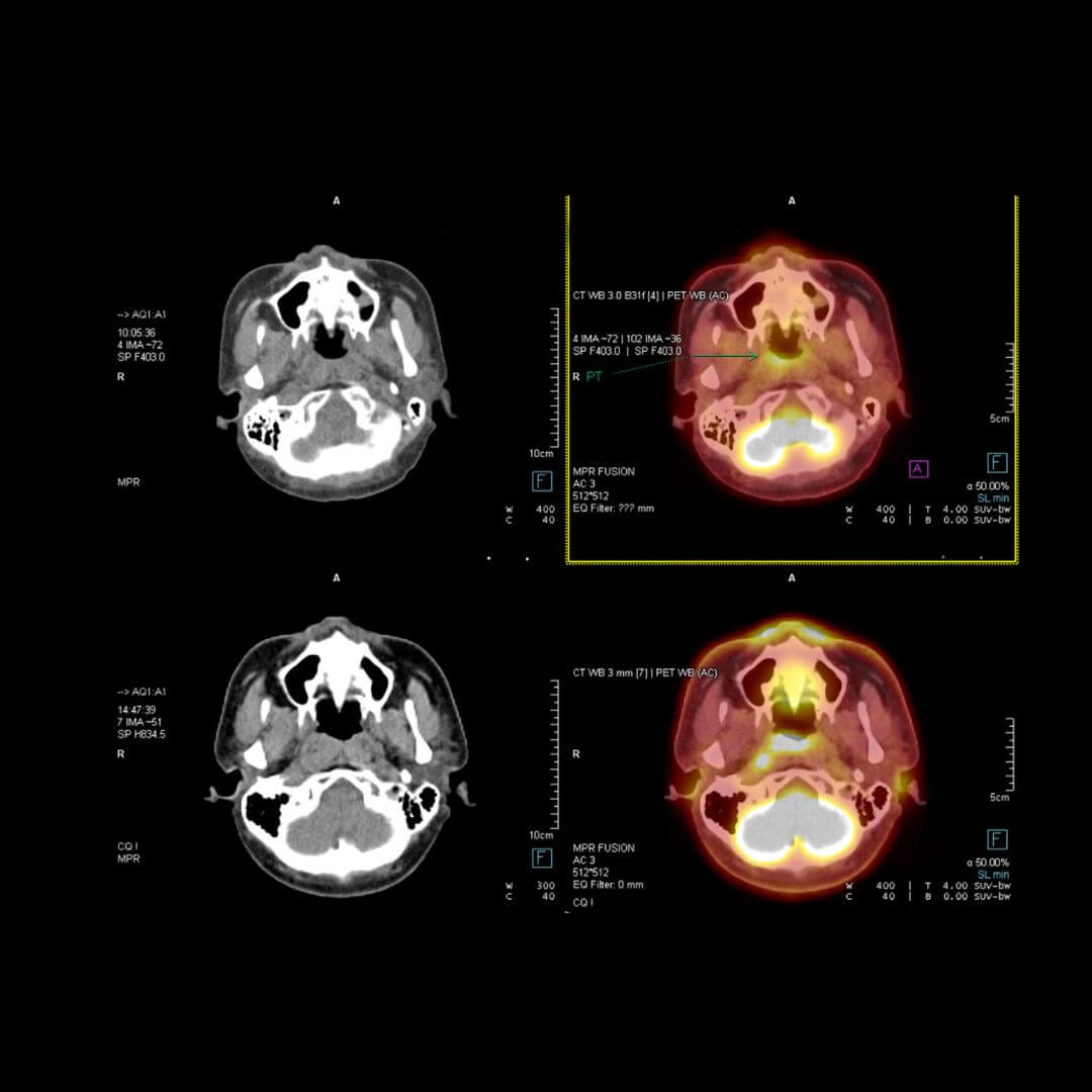 Abnormal PET Scan of Heart – Causes, Meaning, Symptoms & Next Steps